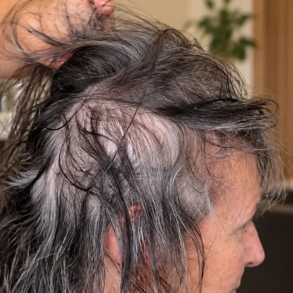 Donna con capelli sottili o diradati, poco volume e chioma poco folta, caratteristiche dei capelli fini e deboli che necessitano di trattamenti cosmetici volumizzanti e rinforzanti.