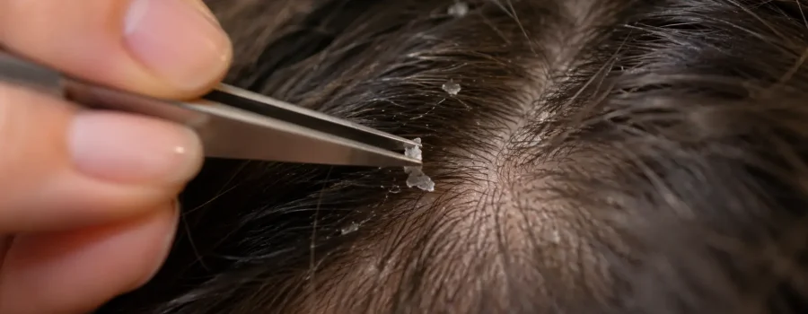 Come rimuovere delicatamente la forfora visibile dal cuoio capelluto in pochi minuti.