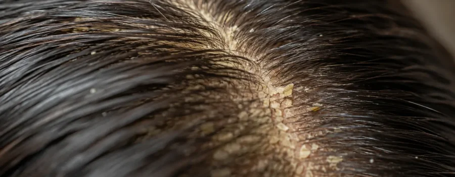Forfora cutanea e biofilm del cuoio capelluto: relazione tra Malassezia, scalp microbiome, microbiota del cuoio capelluto, cute grassa, sebo, equilibrio della barriera cutanea, microrganismi e salute della cute, con desquamazione e forfora visibile tra i capelli.