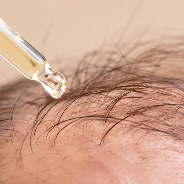 Nuove tecniche di medicina rigenerativa per contrastare il diradamento dei capelli con applicazione di siero sul cuoio capelluto e trattamento mirato alla stimolazione della ricrescita capillare.