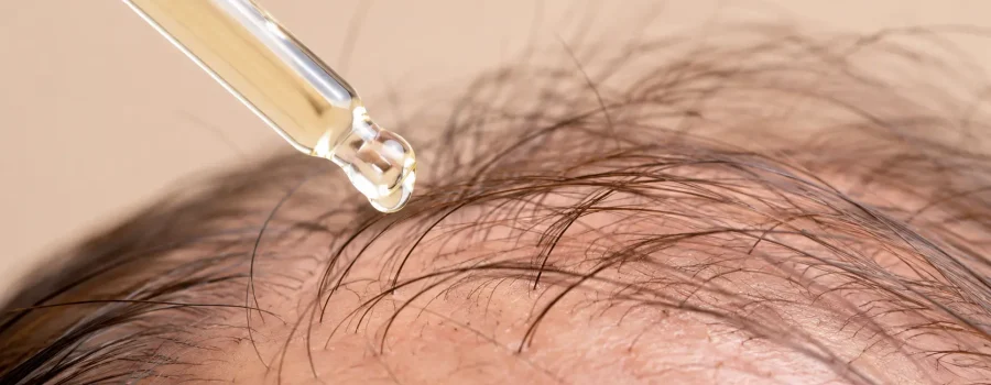 Nuove tecniche di medicina rigenerativa per contrastare il diradamento dei capelli con applicazione di siero sul cuoio capelluto e trattamento mirato alla stimolazione della ricrescita capillare.